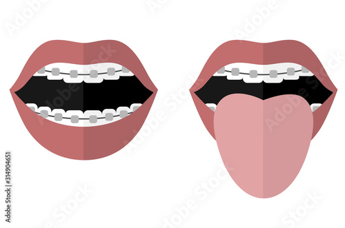 Open mouth with braces and tongue sticking out. Vector image. Flat design