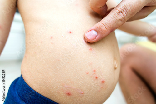 .chickenpox treatment. the manâ€™s hand ointments a red rash on the childâ€™s body.