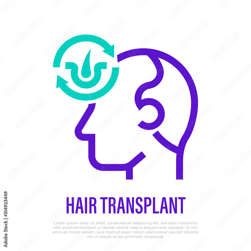 Hair transplantation thin line icon. Hair folicles in arrows. Medical procedure of extraction follicles. Vector illustration. Hair transplantation thin line icon. Hair folicles in arrows. Medical procedure of extraction follicles. Vector illustration.