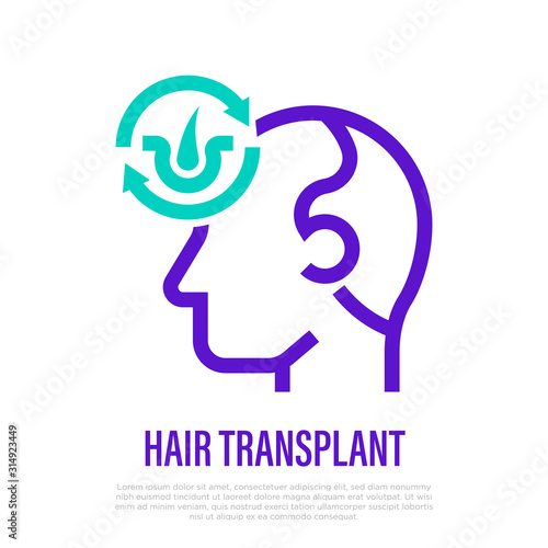 Hair transplantation thin line icon. Hair folicles in arrows. Medical procedure of extraction follicles. Vector illustration.