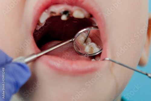 Close up of dentist's hands with assistant in blue gloves are treating teeth to a child, patient's face is closed