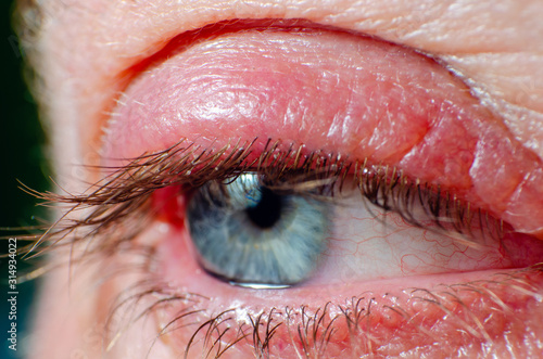 Photos Irritated infected red bloodshot eye, barley infection in the eye