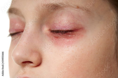 Allergic reaction, skin rash, close view portrait of a girl's face. Redness and inflammation of the skin in the eyes and lips. Immune system disease.