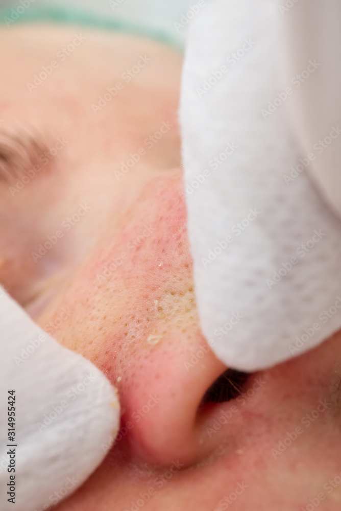 Beautician removes - squeezes acne from the face of a young beautiful girl. The concept of cosmetology. The cosmetologist performs the procedure to cleanse the face with problem skin. Beautician removes - squeezes acne from the face of a young beautiful girl. The concept of cosmetology. The cosmetologist performs the procedure to cleanse the face with problem skin.