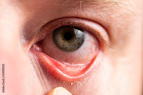 Reddened eye with suppuration on eyelashes closeup