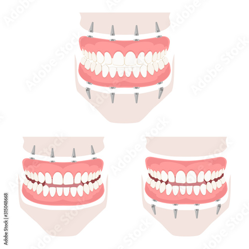 Removable denture of the upper and lower jaw.