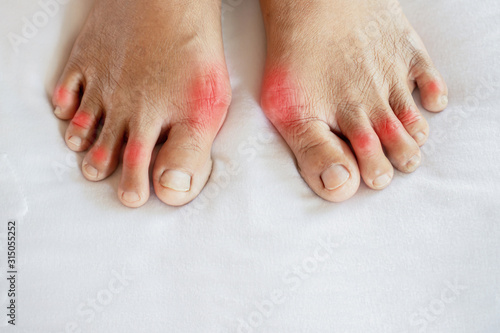 closeup woman feet suffering from joint pain with gout in finger photo