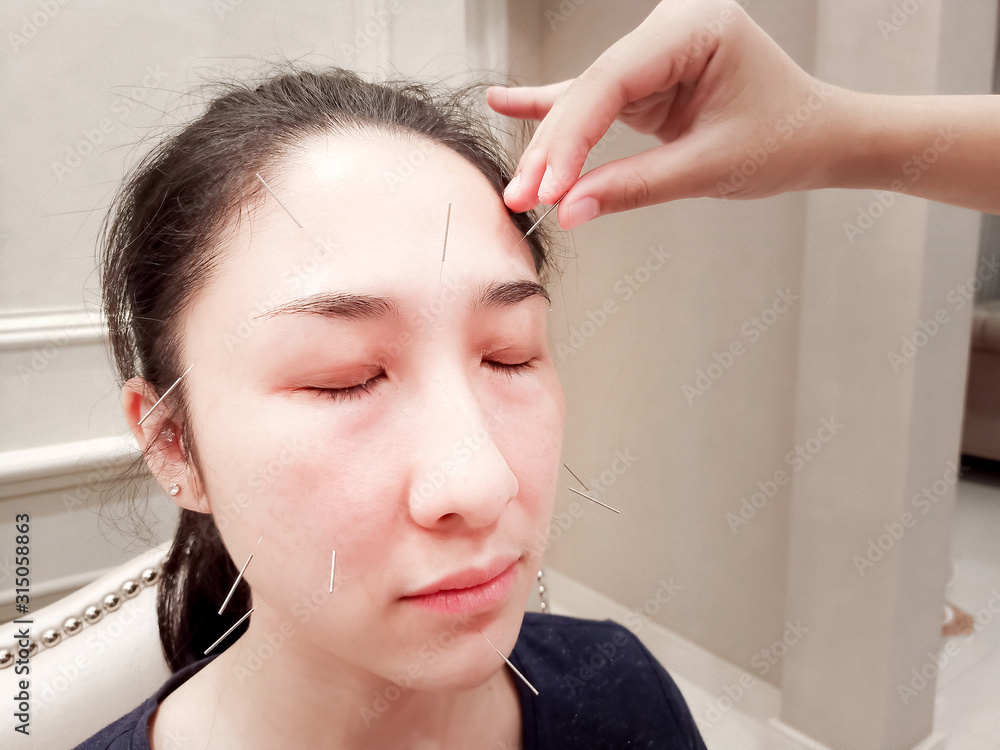 Naklejka premium Doctor sticks needles into the body on acupuncture . Acupuncture needles showing acupuncture points on human body to heal and relax therapy. Body Acupuncture Science in Traditional Chinese Medicine.