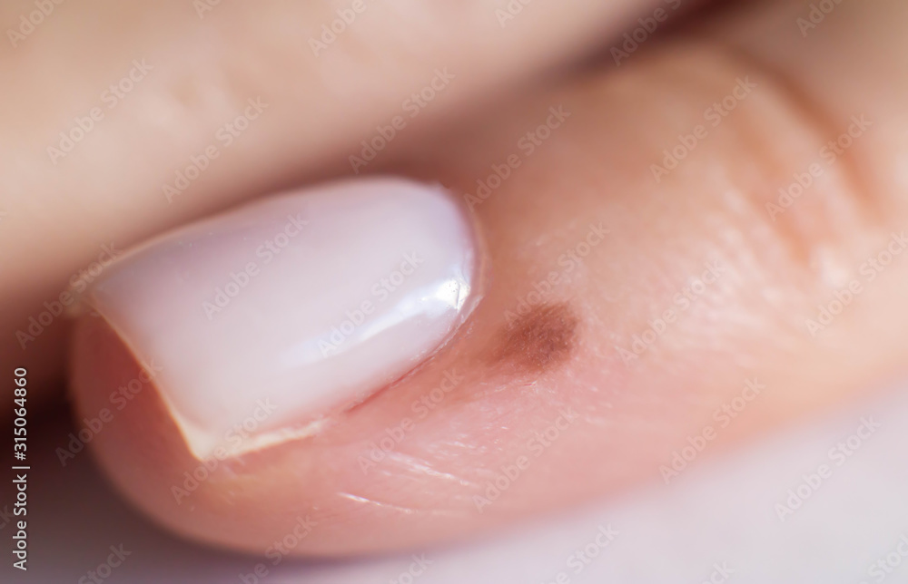 Small mole on a finger near a person s nail, close-up Small mole on a finger near a person s nail, close-up