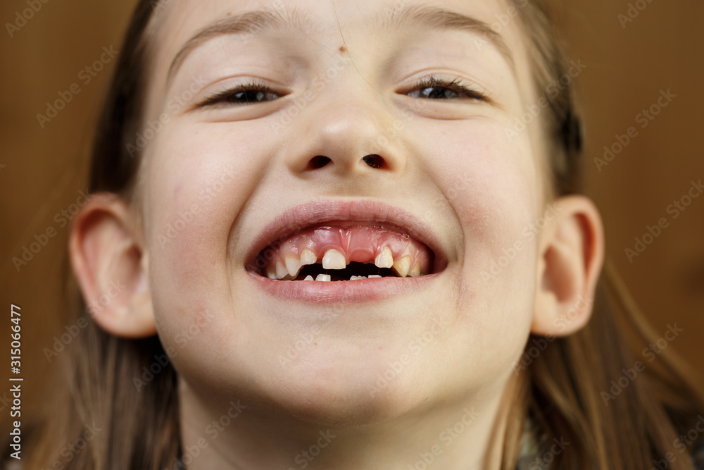 Child smiling, showing her missing milk teeth Child smiling, showing her missing milk teeth