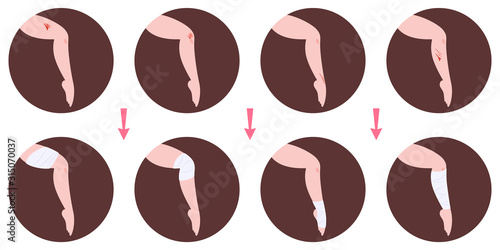 Wounds treatment and bandage application infographics. First aid