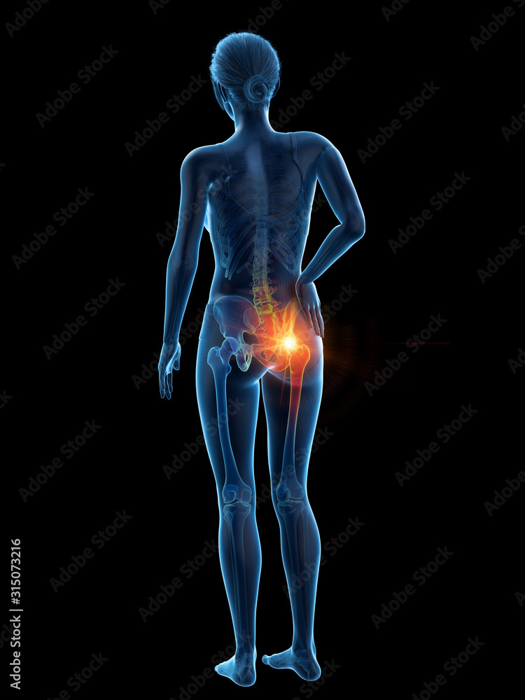 3d rendered medically accurate illustration of a woman having a painful hip 3d rendered medically accurate illustration of a woman having a painful hip