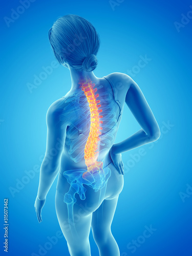 3d rendered medically accurate illustration of a woman having backache