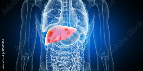 3d rendered medically accurate illustration of liver tumors