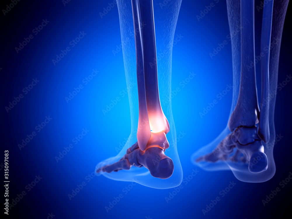 Fototapeta 3d rendered medically accurate illustration of a painful ankle