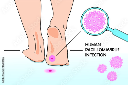 Medical illustration of an infection of the DNA virus - human papillomovirus. Feet on the floor and HPV virus model under a magnifying glass.