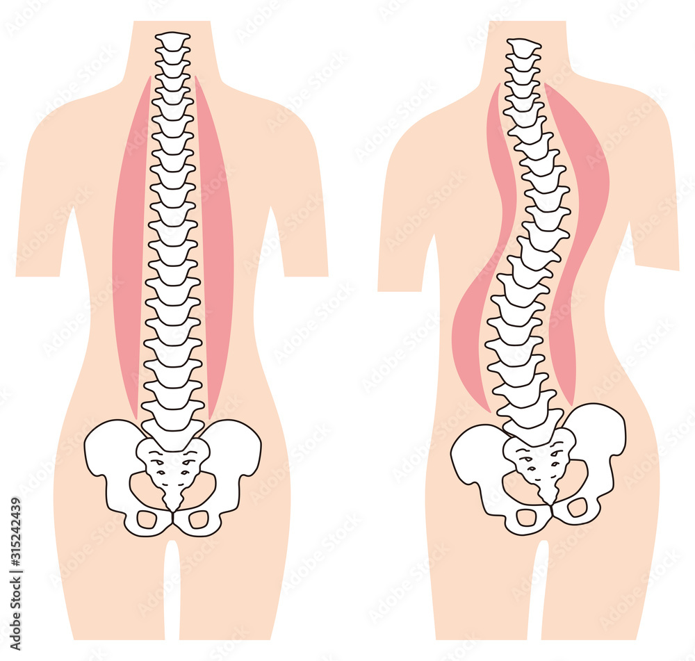まっすぐな背骨 歪んだ背骨 脊椎側弯症 Stock イラスト Adobe Stock まっすぐな背骨 歪んだ背骨 脊椎側弯症 Stock イラスト Adobe Stock