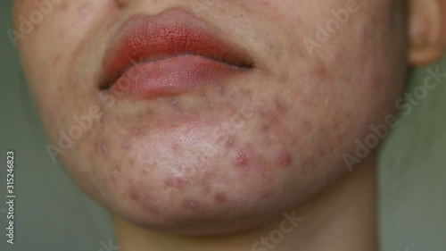 Close up skin problem and acne on Chin and face of women. 