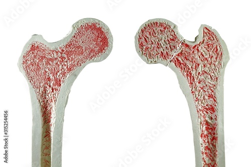 Normal and fractured hip