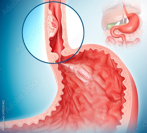 Oesophageal cancer, illustration photo
