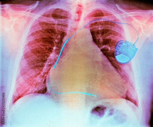 Pacemaker in heart disease, X-ray photo