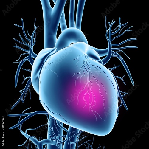 Heart attack, conceptual artwork