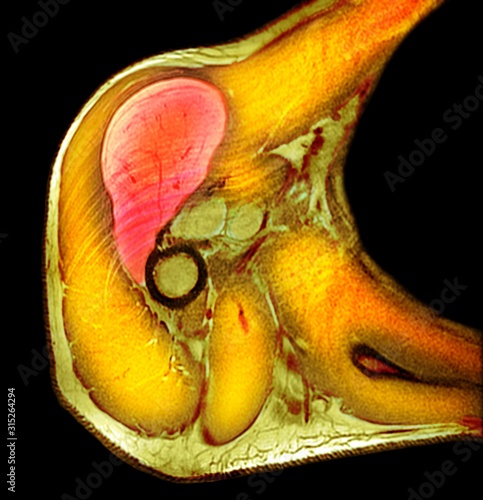 Lipoma of the shoulder, X-ray photo