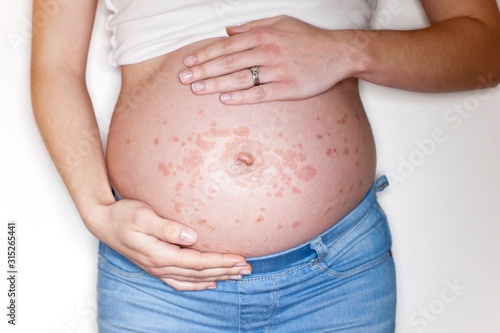 Pregnant woman touching rash on abdomen