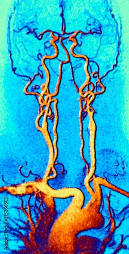 Chest, neck and head arteries, MRA scan photo