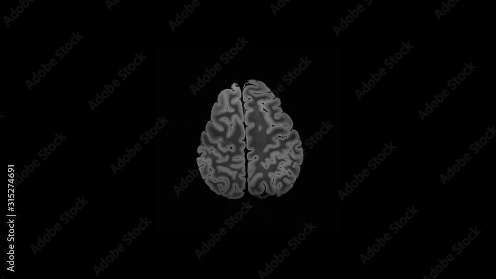 Mri Brain Scan,magnetic Resonance Imaging Of A Brain, Full HD, Time Lapse. Mri Brain Scan,magnetic Resonance Imaging Of A Brain, Full HD, Time Lapse.