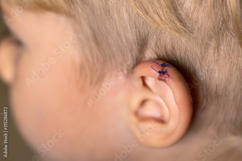 Torn wounds with stitches on child ear. laceration human ear with suture. wound stitches. Medical, surgical concept. photo