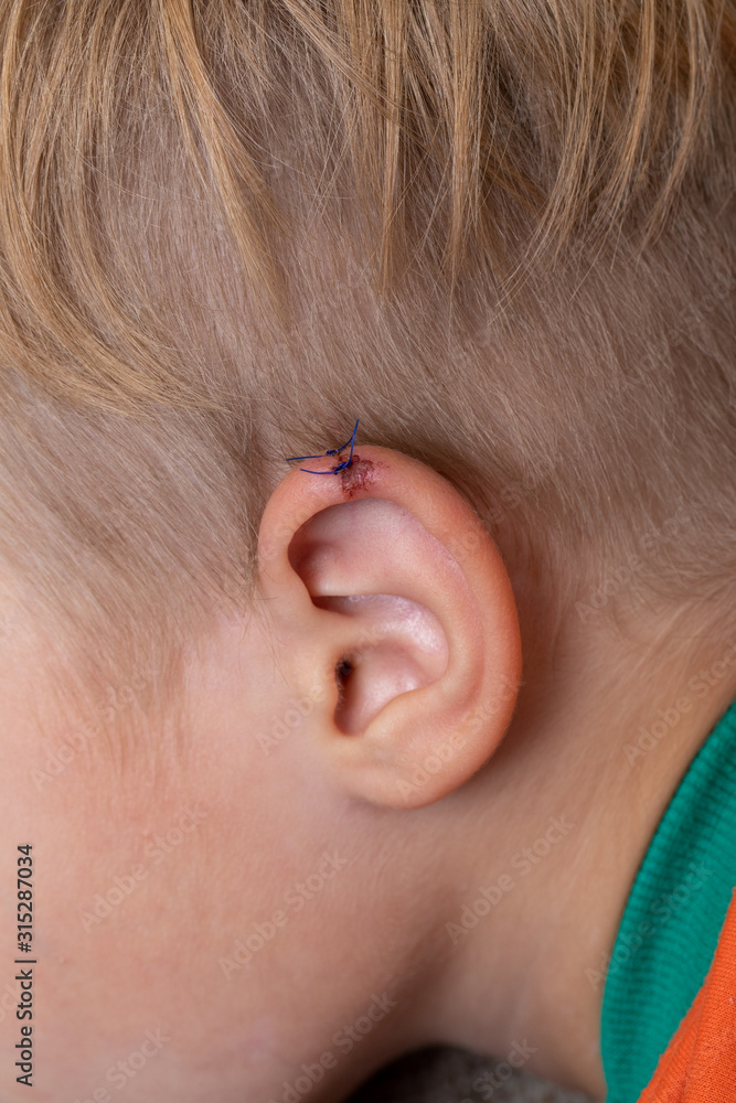 Wound stitches. Medical, surgical concept. closeup of laceration human