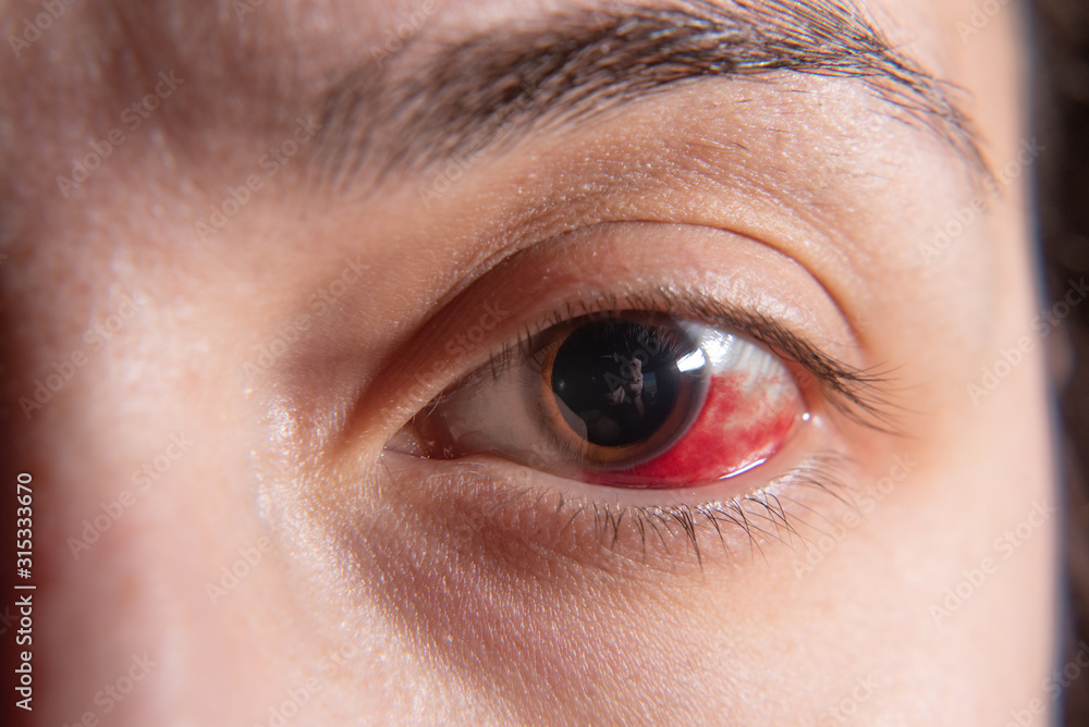 Hemorrhage in the eye of a girl. Abrasion of the cornea. Macro.