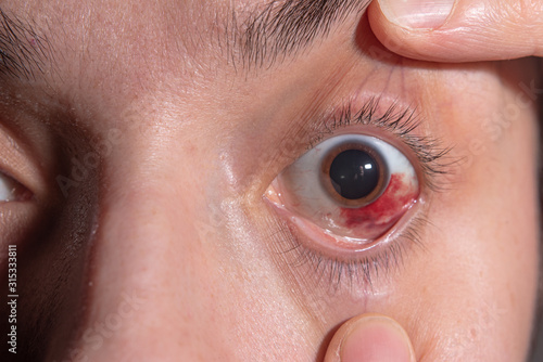 Hemorrhage in the eye of a girl. Abrasion of the cornea. Macro.
