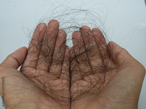 Hair falling out is on two hands with the white background. The causes of hair loss in men or women include oily scalp, hormonal imbalance, thyroid disease, genetic, and stressful events.