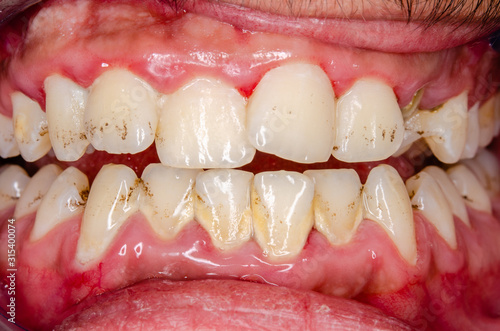 entzündetes zahnfleisch durch mangelnde mundhygiene