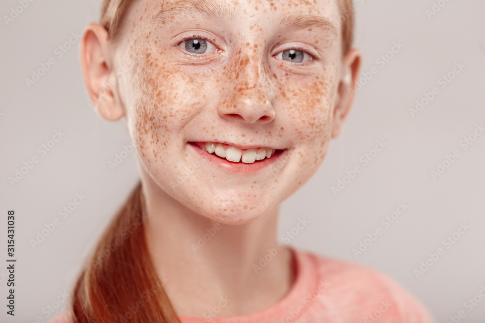 Inclusive Beauty. Girl with freckles standing isolated on grey smiling toothy face close-up Inclusive Beauty. Girl with freckles standing isolated on grey smiling toothy face close-up