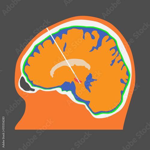 DBS at subthalamic nucleus for the treatment of parkinson's disease