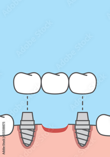 Blank banner Bridges teeth implant illustration vector on blue background. Dental concept.