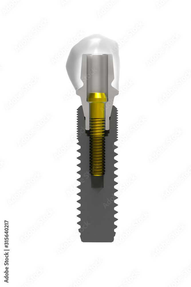 Sectional view of Dental Prosthesis, Abutment, Fastener and Tooth. 3D Illustration Isolated on White Background. Sectional view of Dental Prosthesis, Abutment, Fastener and Tooth. 3D Illustration Isolated on White Background.