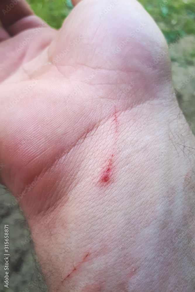 Fototapeta premium A wound on old woman wrist made scar on skin of body.