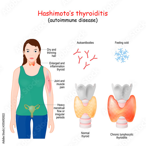 Hashimoto's thyroiditis. chronic lymphocytic thyroiditis