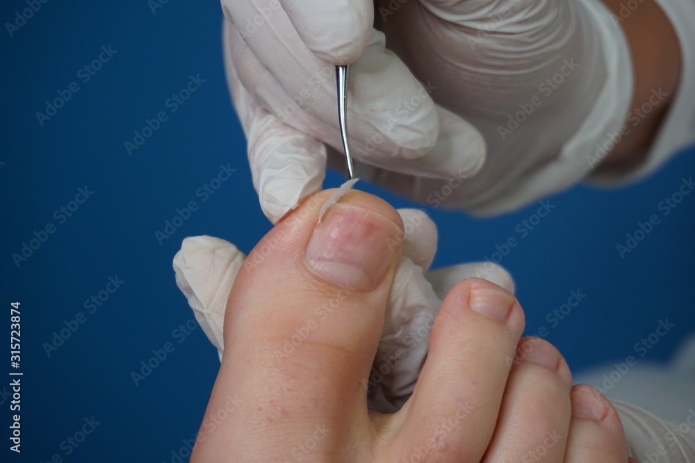 Podiatry Chiropodist Medical Foot Care Podiatrist Ingrown Toenail 