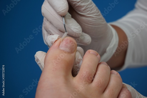 Podiatry  Chiropodist  medical foot care  podiatrist  ingrown toenail  fix an ingrown toenail