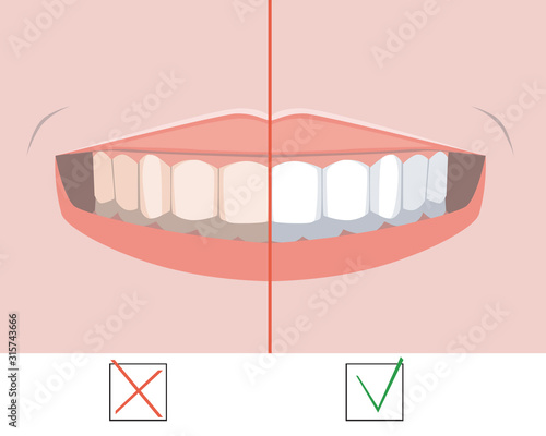 A molars before and after whitening, a flat vector stock illustration as a concept of dental treatment and orthodontic and dental services