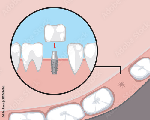 A molar or tooth implant on a pin and a healthy gum, a vector stock illustration with a tooth as a treatment concept for a dental or orthodontic clinic