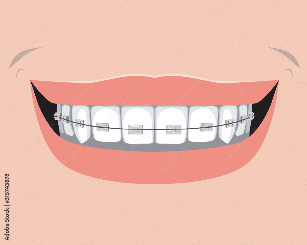 A ceramic braces with incisors and molars, a flat vector stock illustration with a smile as a concept of dental treatment and orthodontic and dental services A ceramic braces with incisors and molars, a flat vector stock illustration with a smile as a concept of dental treatment and orthodontic and dental services