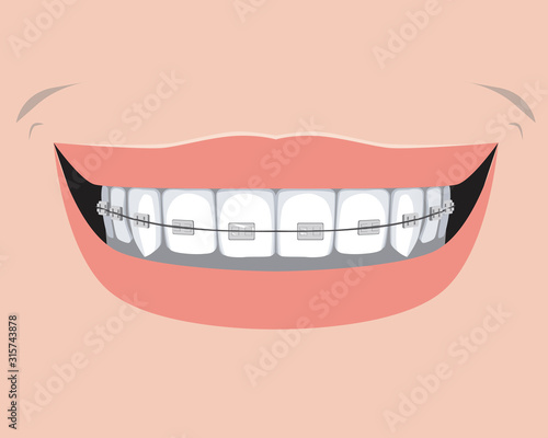 A ceramic braces with incisors and molars, a flat vector stock illustration with a smile as a concept of dental treatment and orthodontic and dental services
