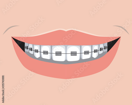 A metal braces with molars and smile of an adult or child, a flat vector stock illustration as a concept of dental treatment and orthodontic and dental services