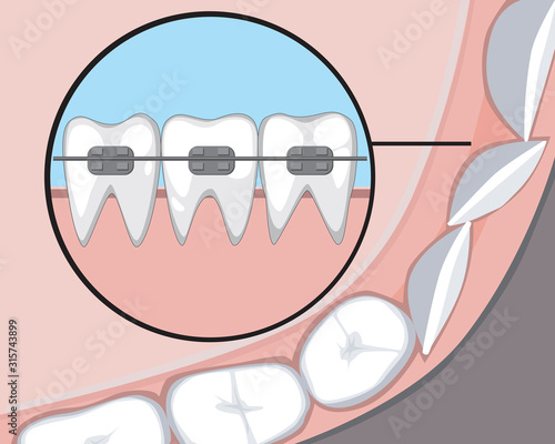 A molar or incisor with braces and a healthy gum, a vector stock illustration with a tooth as a treatment concept for a dental or orthodontic clinic